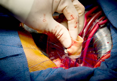 Surgery to replace a heart valve